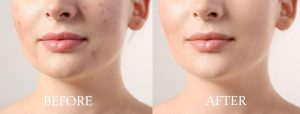 Unlocking Clear Skin: Science-Backed Strategies to Reduce Acne Breakouts